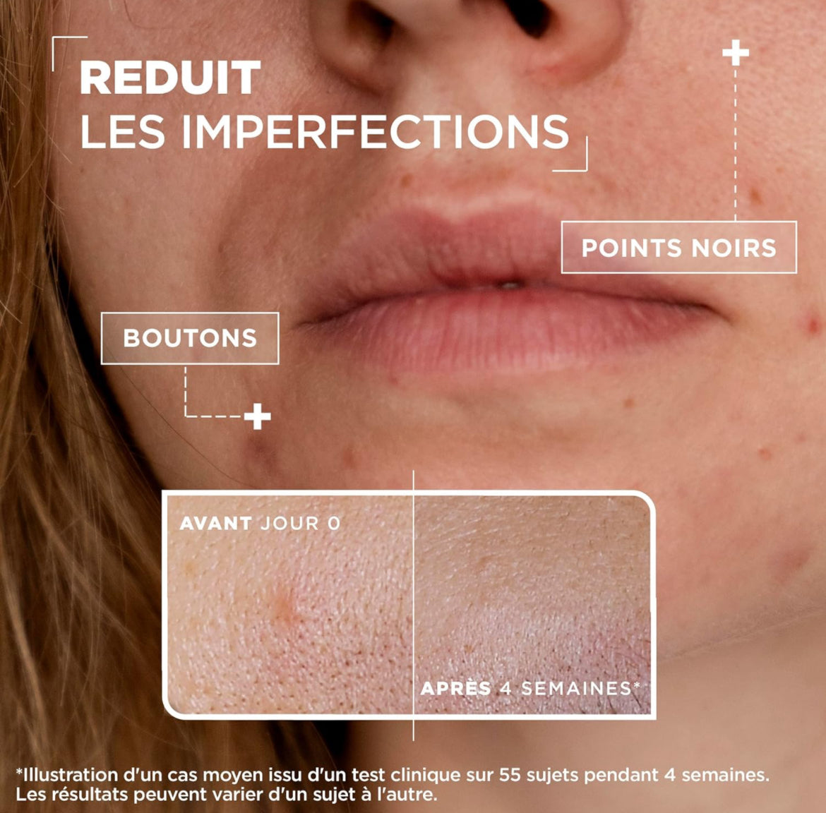 Mixa Sérum Concentré Anti-Imperfections Pour peaux à imperfections Enrichi en Acide Salicylique et Niacinamide