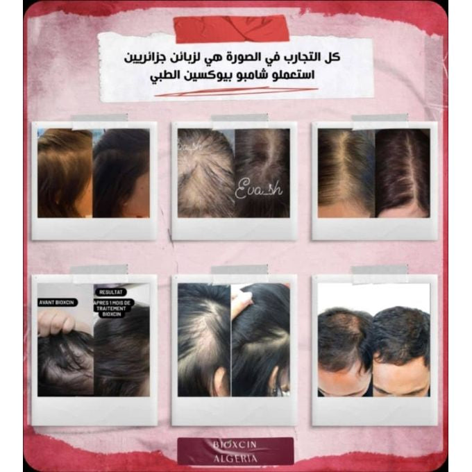 شامبو بيوكسين النباتي بالثوم الأسود ضد تساقط الشعر، عديم الرائحة، يمنع تساقط الشعر للنساء والرجال