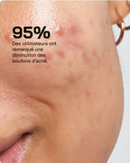 Touché Sérum Anti Acné